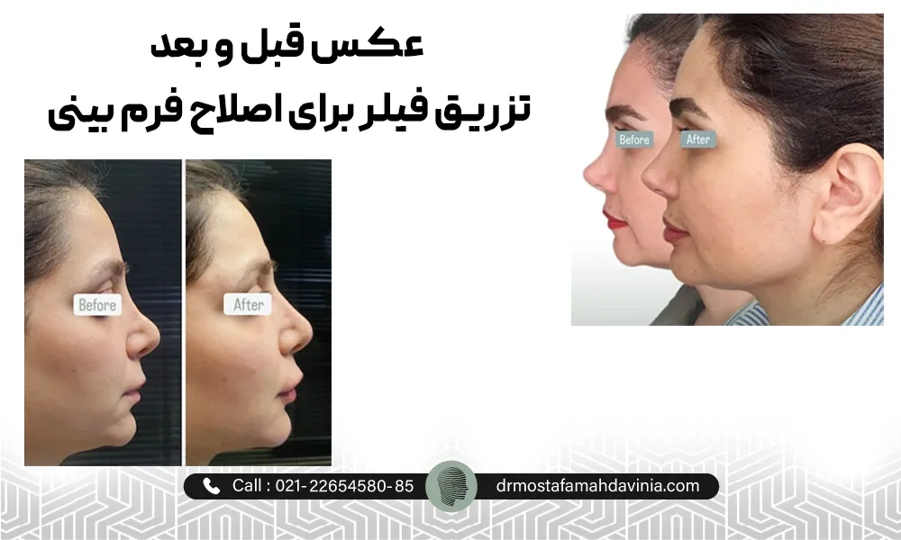 عکس های قبل و بعد اصلاح قوز بینی با تزریق ژل توسط دکتر مصطفی مهدوی نیا