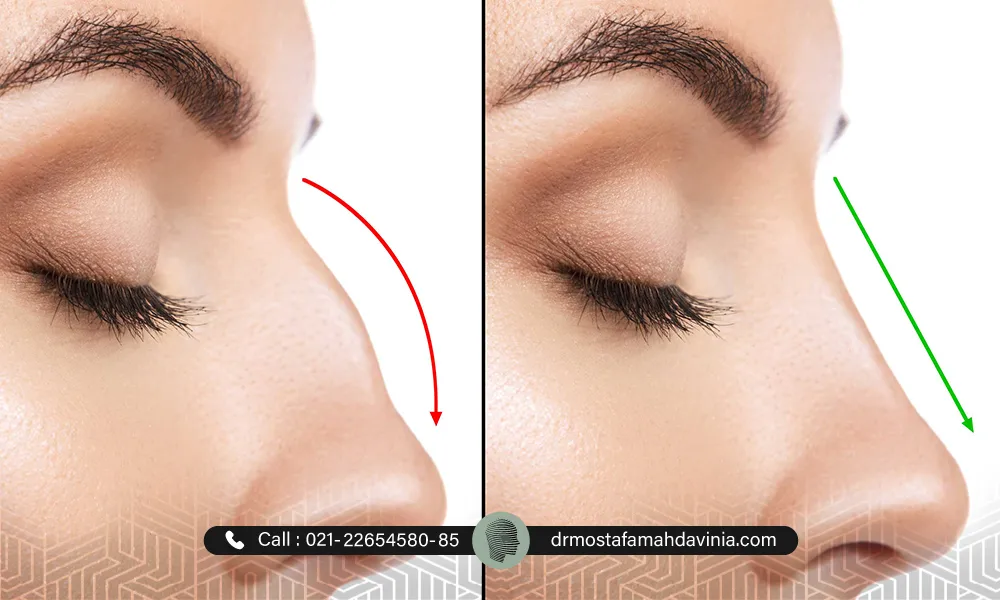 اصلاح فرم بینی با تزریق ژل توسط دکتر مهدوی نیا