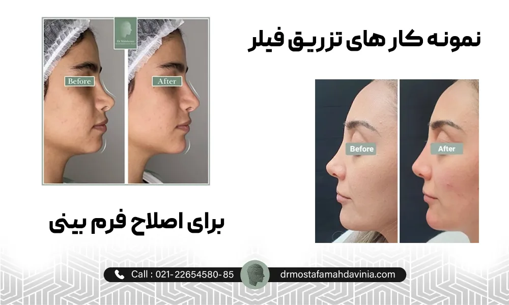 نمونه کار های اصلاح قوز بینی با تزریق ژل