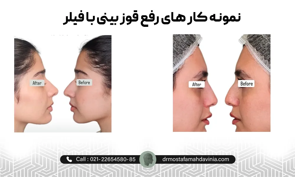 عکس قبل و بعد اصلاح قوز بینی با تزریق ژل