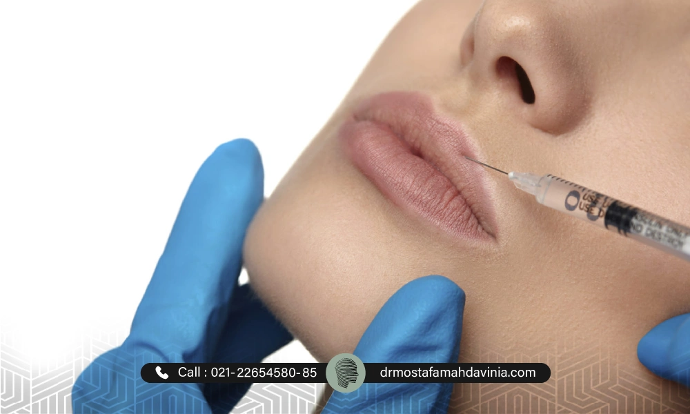 مدل تزریق فیلر لب طبیعی برای یک خانم