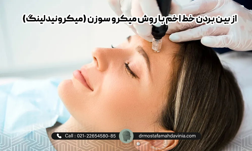 درمان خط اخم عمیق با میکرونیدلینگ برای یک خانم