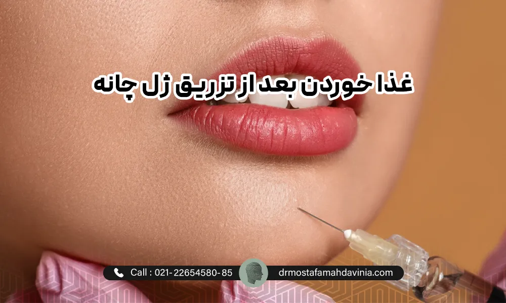 تزریق فیلر به چانه خانمی با لب های قرمز | مراقبت بعد از فیلر چانه​
