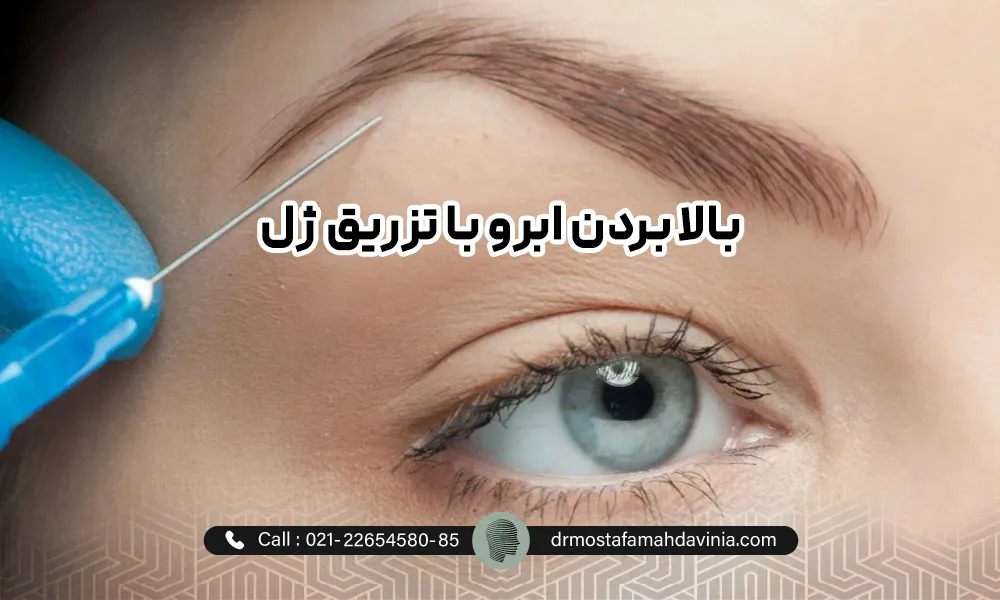 تزریق ژل ببه ابرو ها برای بالا بردن ابرو
