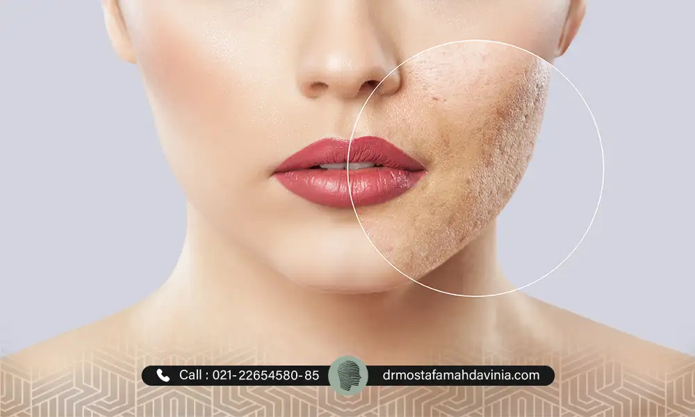 عکس قبل و بعد تزریق فیلر جای جوش