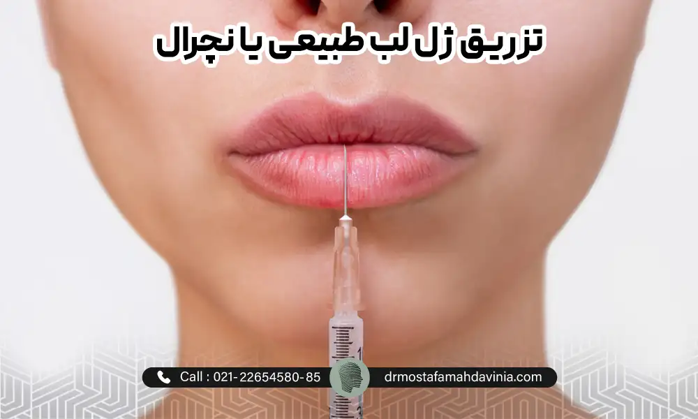 تزریق ژل لب طبیعی یا مدل نچرال