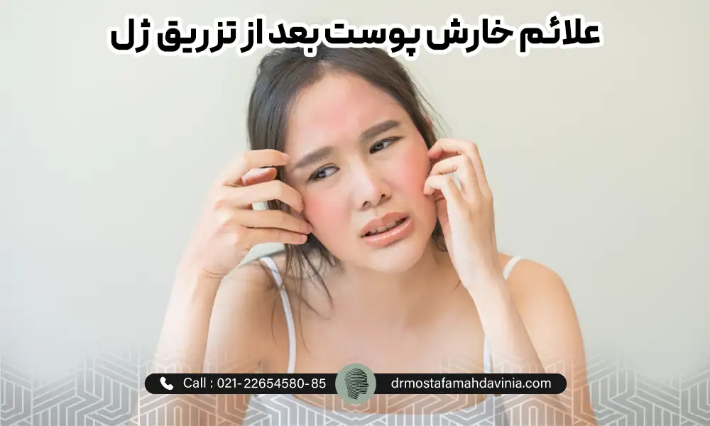خانمی با صورت قرمز با خارش بعد از تزریق ژل