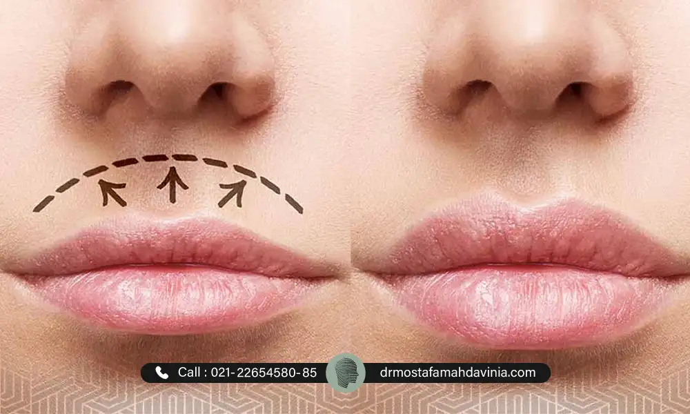 عکس قبل و بعد لیفت لب با نخ