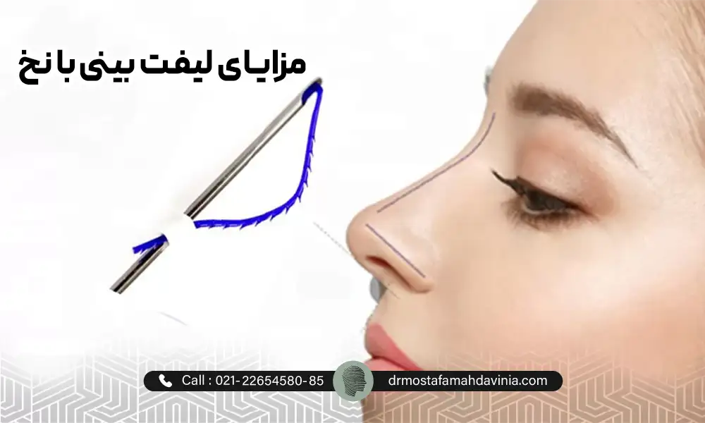 نخ لیفت بینی و طریقه ورود نخ به بینی در لیفت بینی با نخ