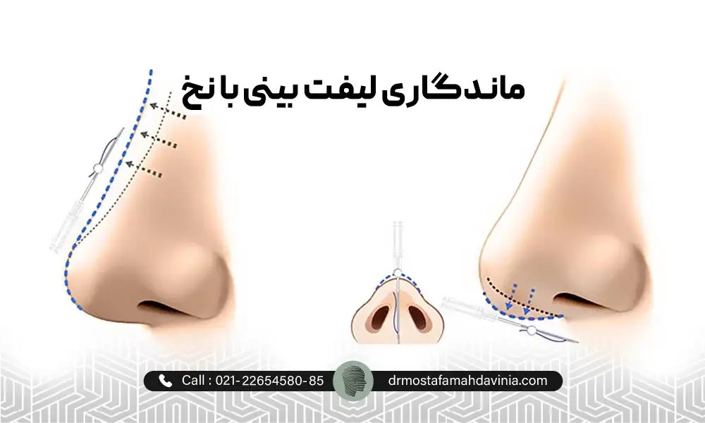 عکس نحوه های وارد کردن نخ بینی در لیفت بینی با نخ