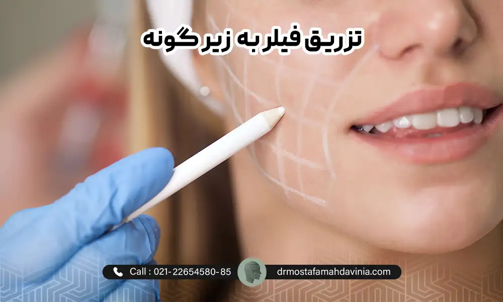 مشخص کردن نواحی تزریق ژل به گونه در تزریق فیلر زیر گونه