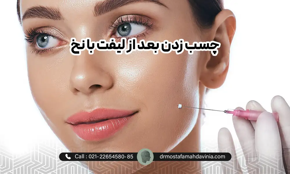 لیفت نخ گونه برای خانمی با چشمان رنگی و لبخند روی لب | مراقبت های بعد از لیفت نخ