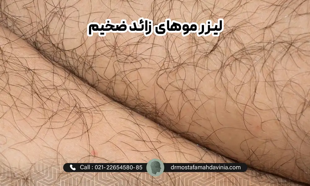 موهای ضخیم پاها قبل از لیزر | بهترین دستگاه‌ لیزر برای موهای ضخیم