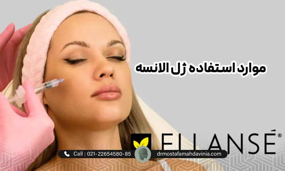 تزریق فیلر الانسه به صورت یک خانم