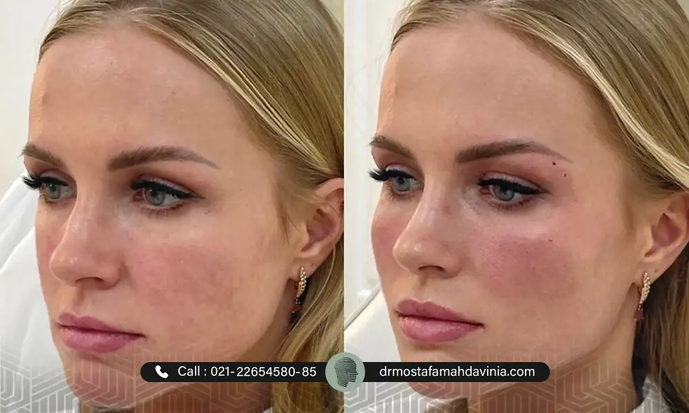 تصویر قبل و بعد تزریق فیلر فول فیس