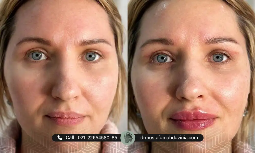 عکس قبل و بعد تزریق فیلر فول فیس برای خانمی چشم رنگی
