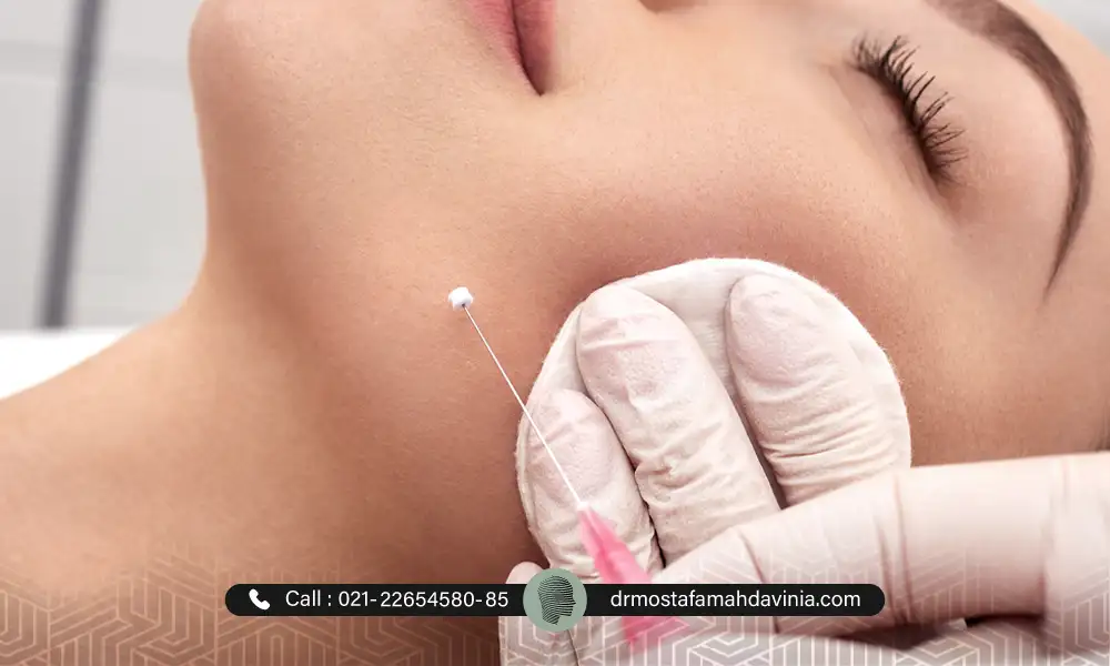 لیفت نخ تهران برای گونه خانم