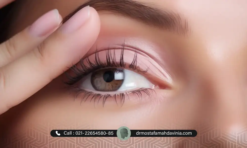 خانمی در حال بالا کشیدن پلک راست خود بعد از لیفت پلک با نخ