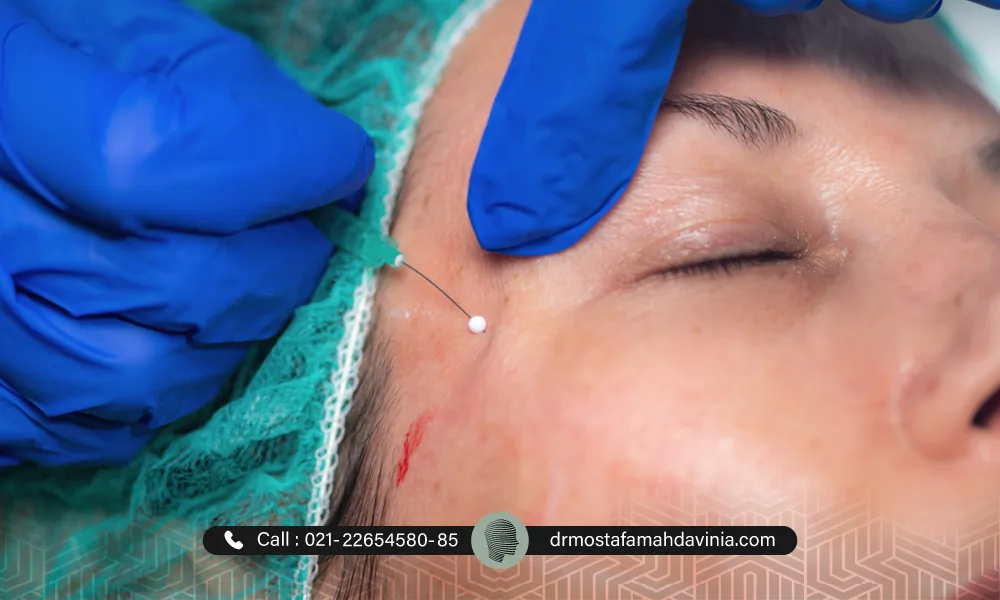 هزینه لیفت با نخ برای نواحی مختلف صورت