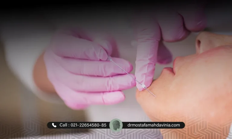 هزینه لیفت با نخ و قیمت لیفت نخ در سال 1404