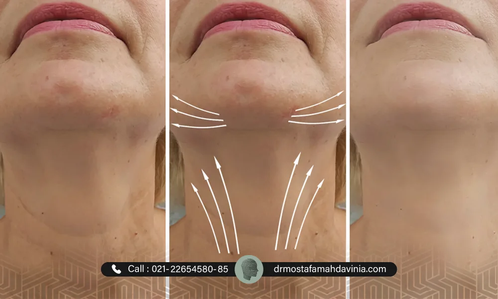 هزینه لیفت گردن و خط فکی با نخ 