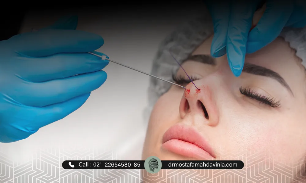 مزایا و معایب لیفت نخ بینی گوشتی