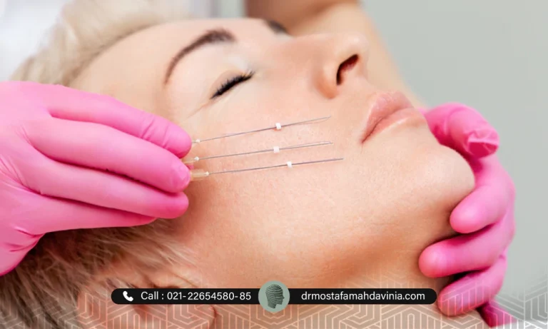 هزینه لیفت صورت با نخ و قیمت لیفت نخ صورت در سال 1404