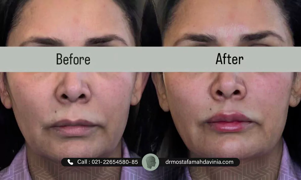 خانمی که لیفت نخ و فیلر انجام داده، لیفت صورت با نخ طلا