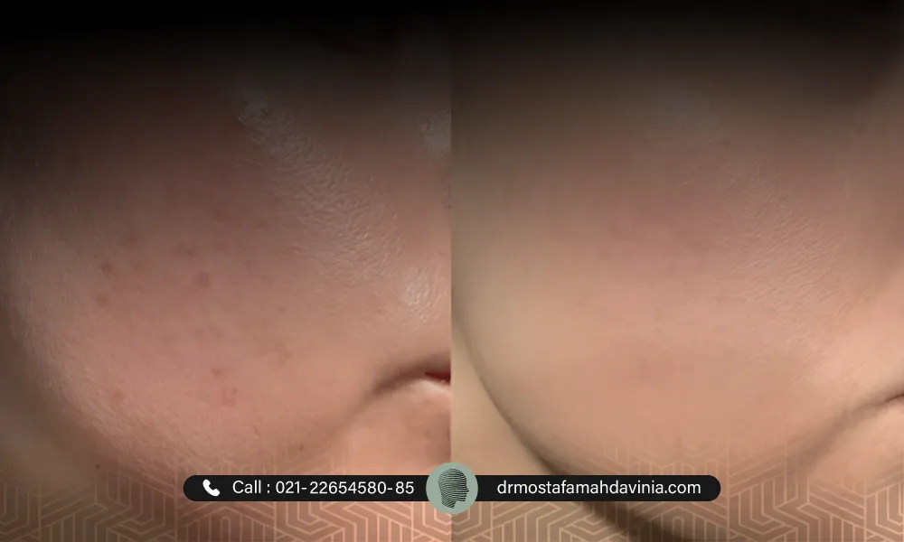 مراقبت های قبل و بعد از سابسیژن