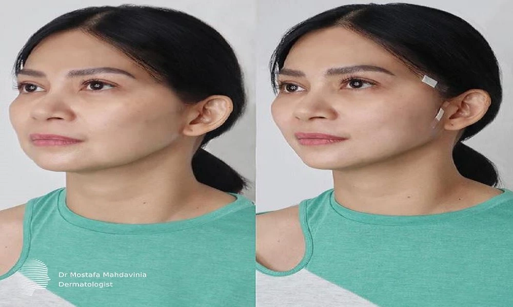 مزایای لیفت با نخ آپتوس