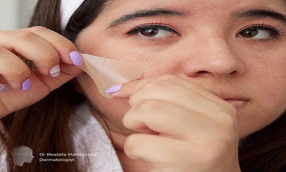 چسب زدن به صورت بعد از لیفت با نخ