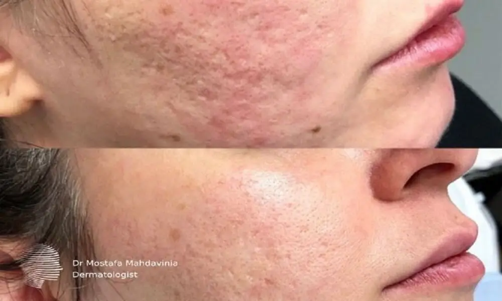 مزایا تزریق ژل و سابسیژن