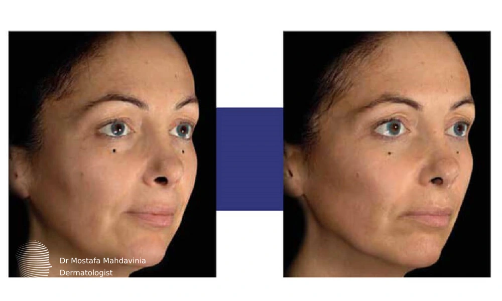 مراقبت های بعد از تزریق پروفایلو استراکچرا